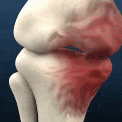 ArthroEase® | Naturlig lindring för artrossmärta