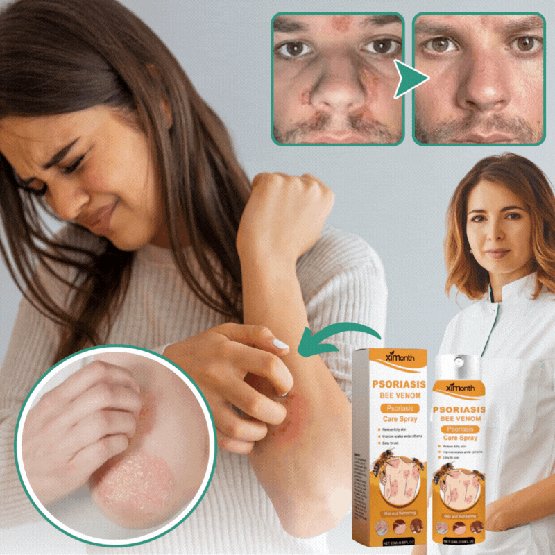 PsoriKlar™ | Eliminerar psoriasis med 92 % på 48 timmar