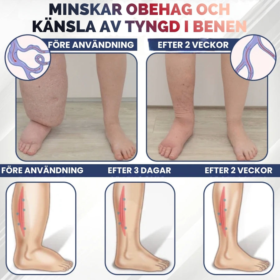 SwelRelief™ | Kräm för lindring av bensvullnad