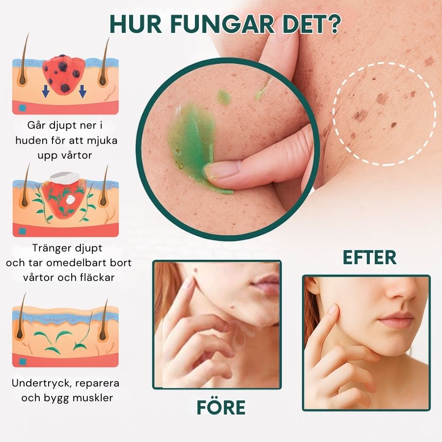 PerfektHud™ | Instantan Födelsemärke- och Fläckborttagningsgel