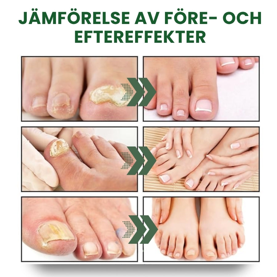 NailHeal™ | Ört-Nagel-Förnyelse-Spray