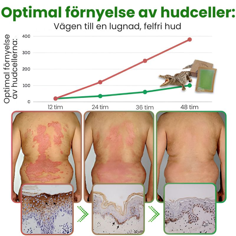 KrokoDerma™ | Krokodiloljetvål för psoriasis och eksem