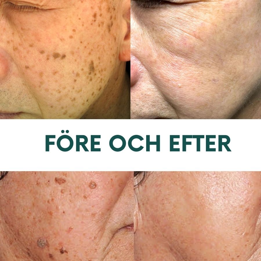 PerfektHud™ | Instantan Födelsemärke- och Fläckborttagningsgel