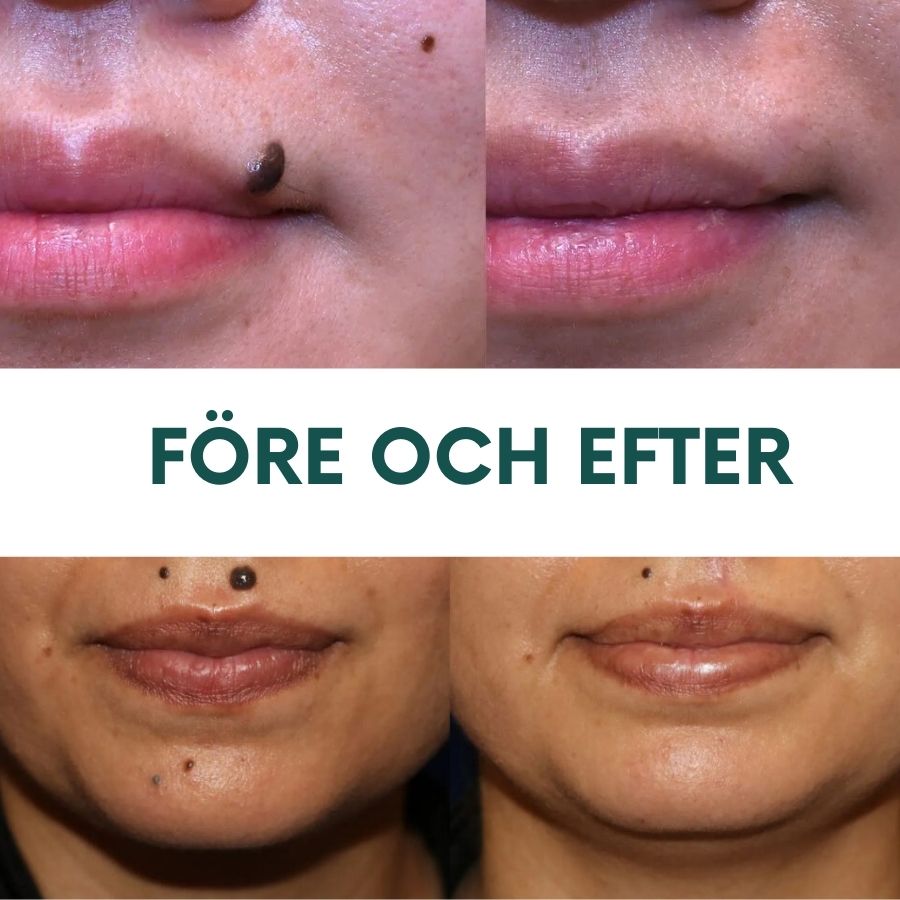 PerfektHud™ | Instantan Födelsemärke- och Fläckborttagningsgel