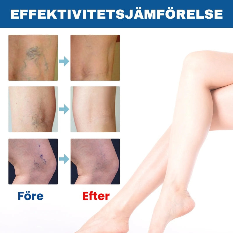 VenoAid™ | Åderbråckslösning Spray