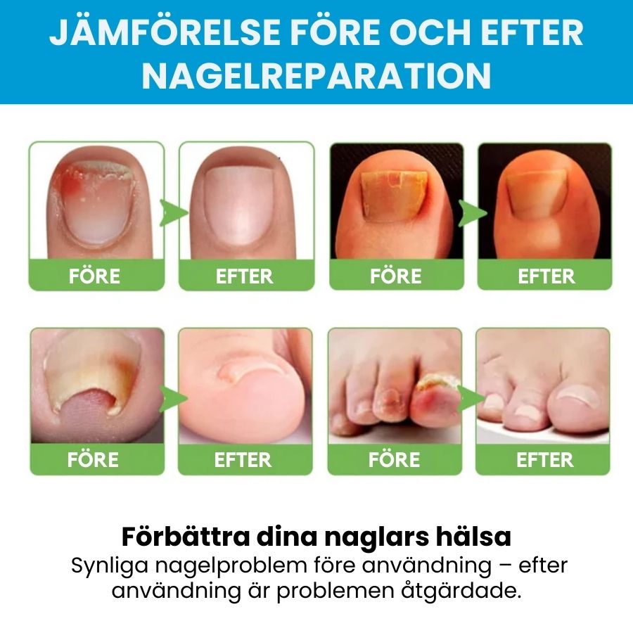 KlarNagel™ | Snabbverkande svampdödande salva