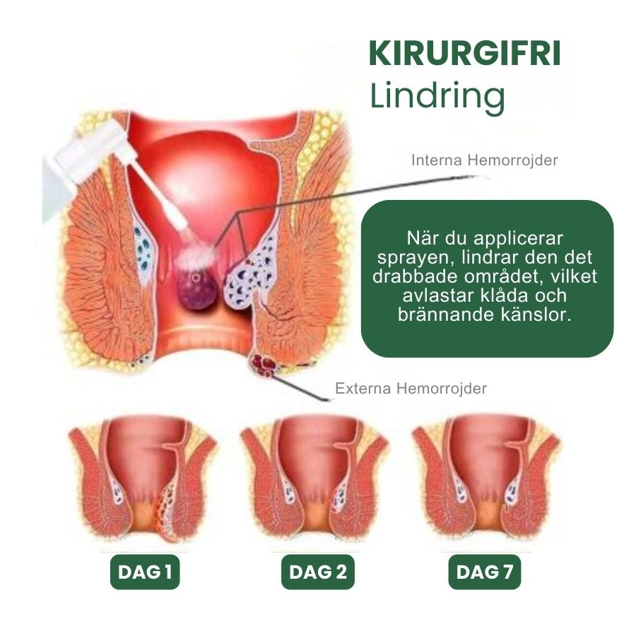 HemoRelief™ | Snabbverkande Hemorrojd-Spray