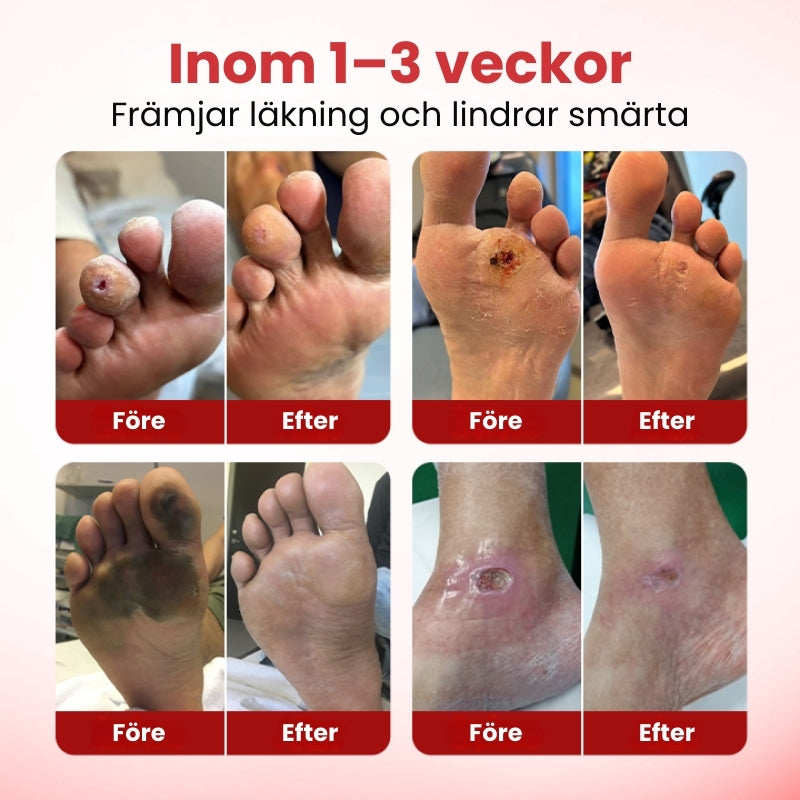 VitaGluco™ | Diabetisk Sårvårdskräm