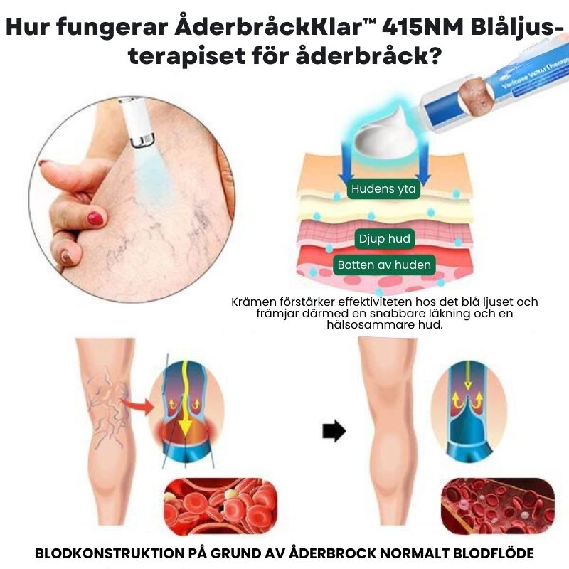 ÅderbråckKlar™ | Fullständig eliminering av åderbråck på bara 4 veckor!