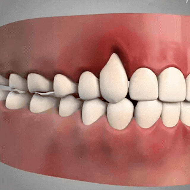 GumFix™ | Oral Spray
