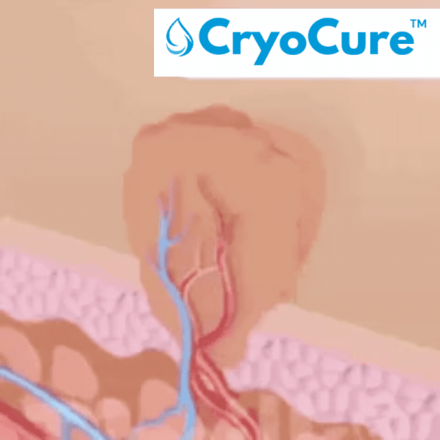 CryoCure™ Spray | Eliminerar envisa vårtor och mjukgör huden på 7 dagar