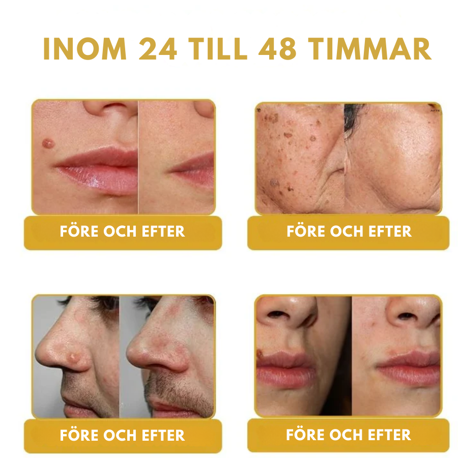 ClearZap™ | tar bort 99 % av alla vårtor på bara 24 timmar