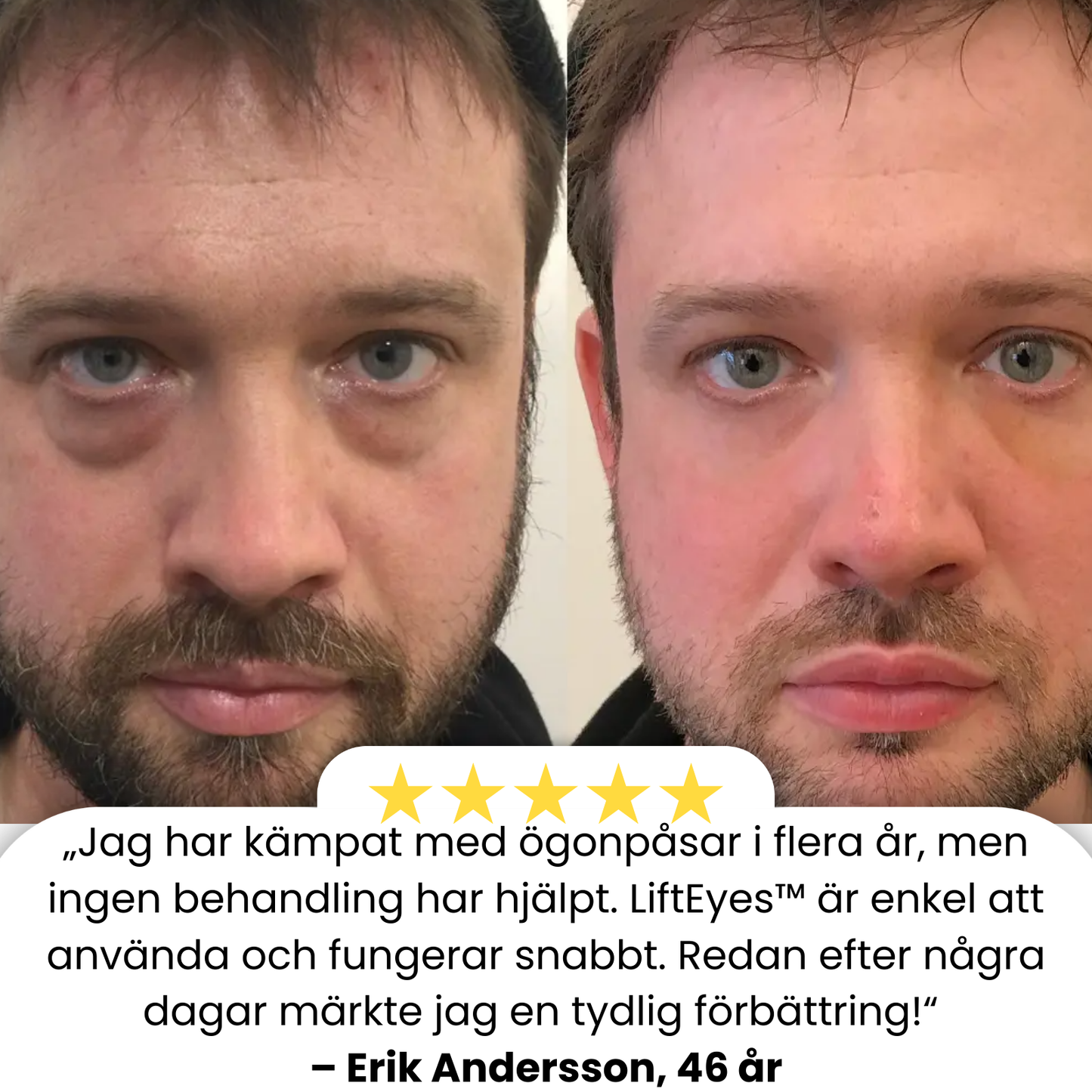 LiftEyes™ | 97% mindre påsar på 60 sek – Ser 10 år yngre ut!