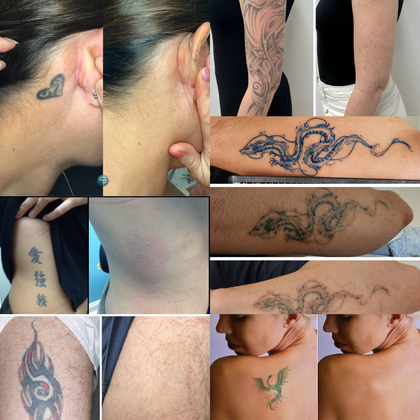 TattBort™ | 99% Tatueringstinte borttagen!
