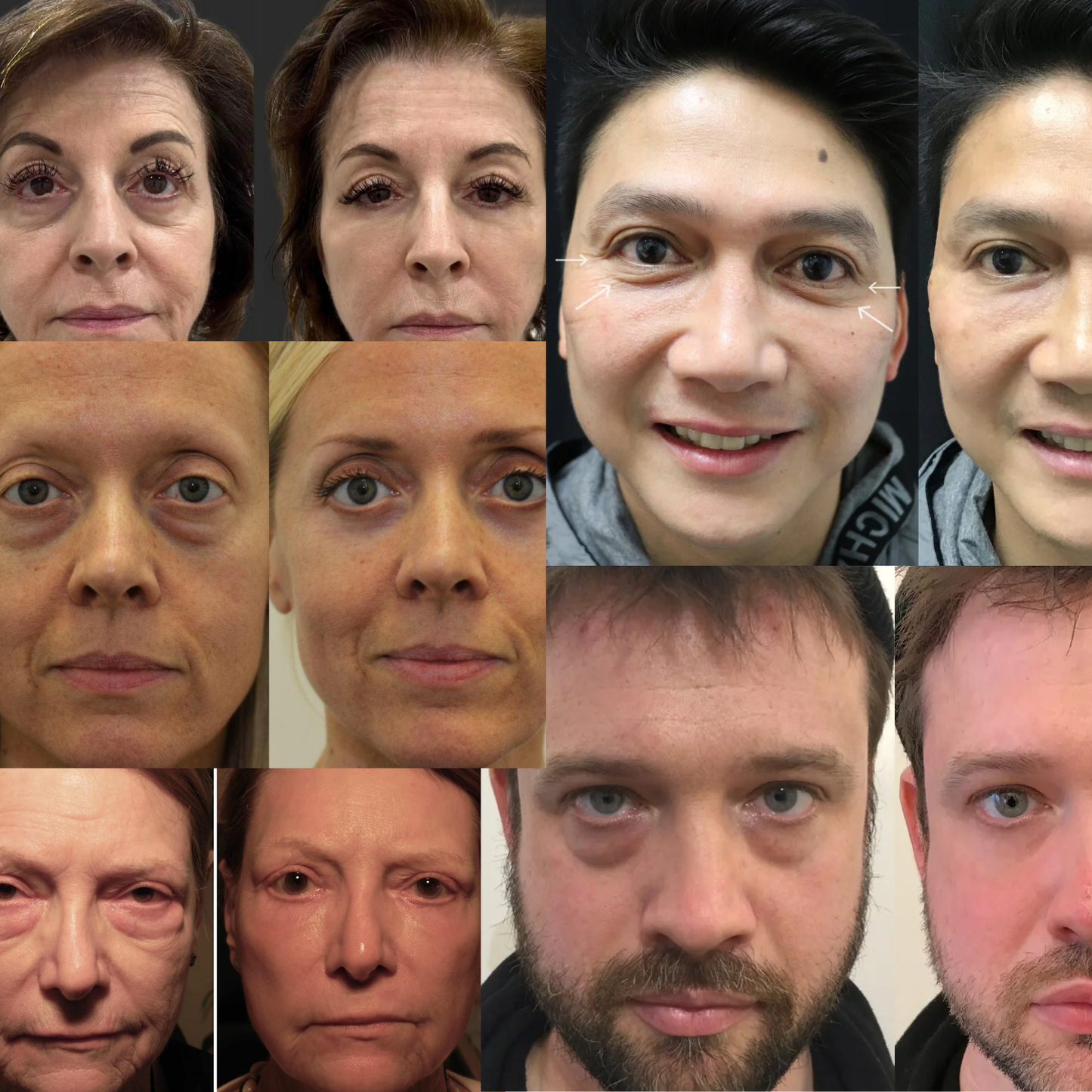LiftEyes™ | 97% mindre påsar på 60 sek – Ser 10 år yngre ut!
