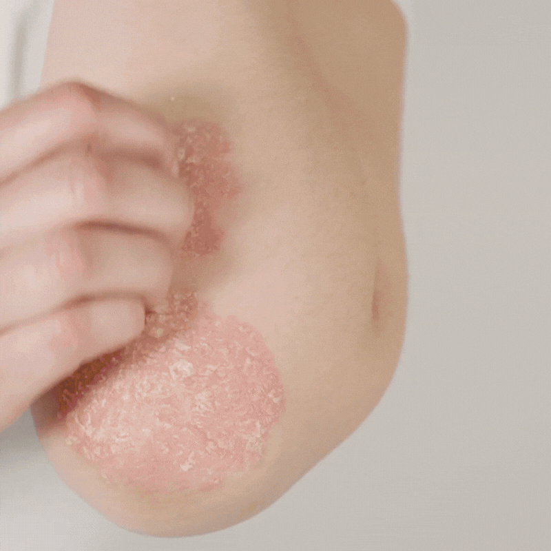 PsoriKlar™ | Eliminerar psoriasis med 92 % på 48 timmar